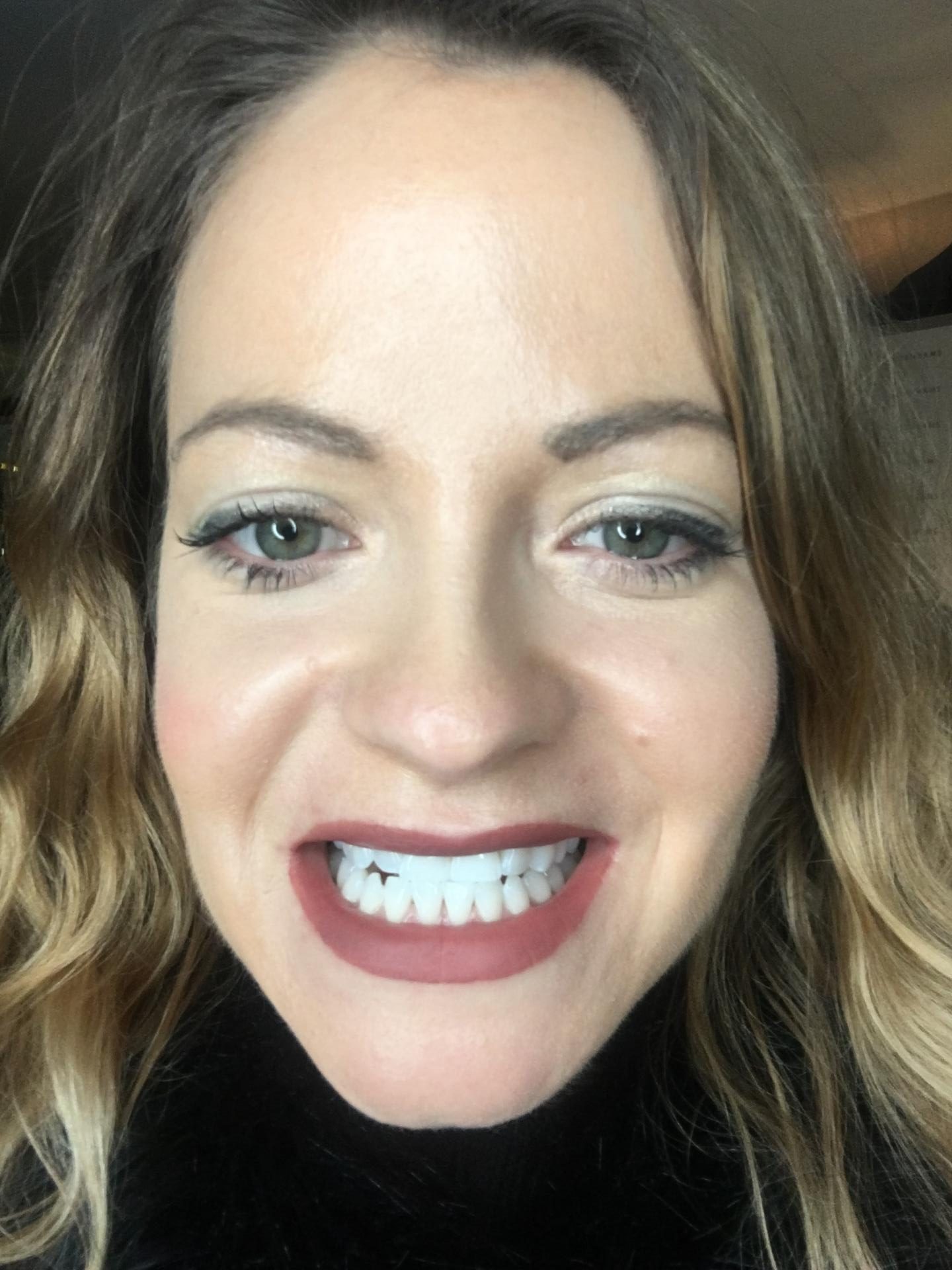 Philips Zoom! Teeth Whitening Treatment - Photo Tutorial By Jamie 5