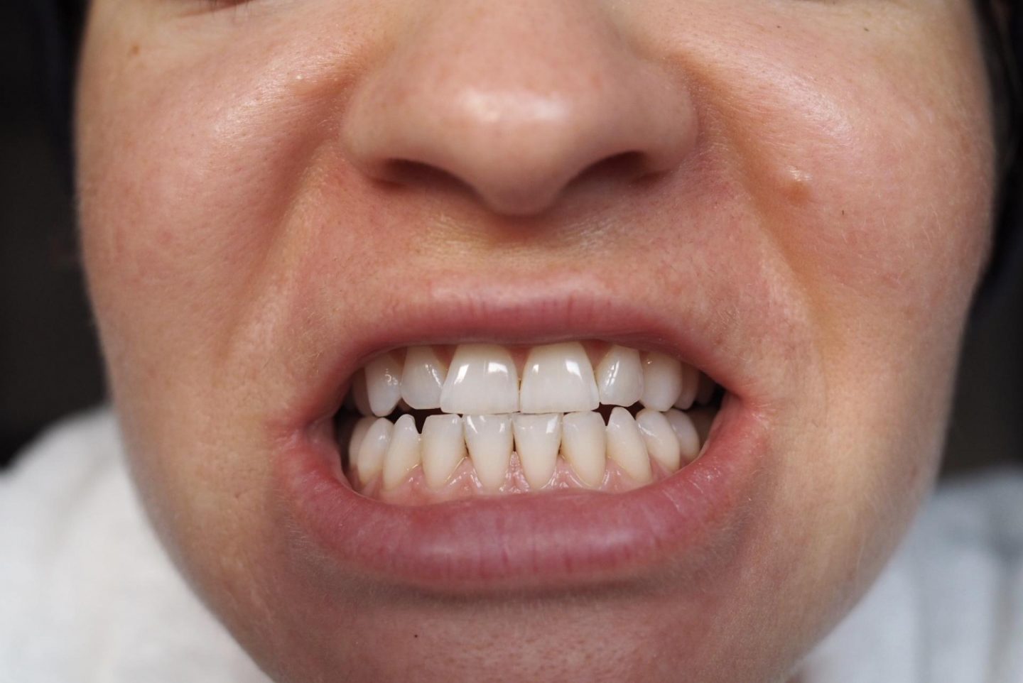 Does. Snow Teeth Whitening Have Hydrogen Peroxide In It ...